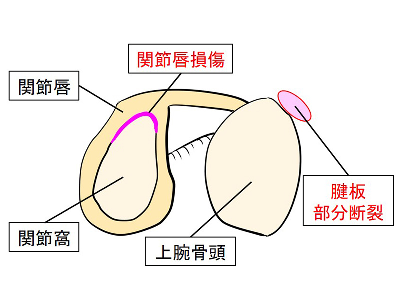 図2：投球障害肩