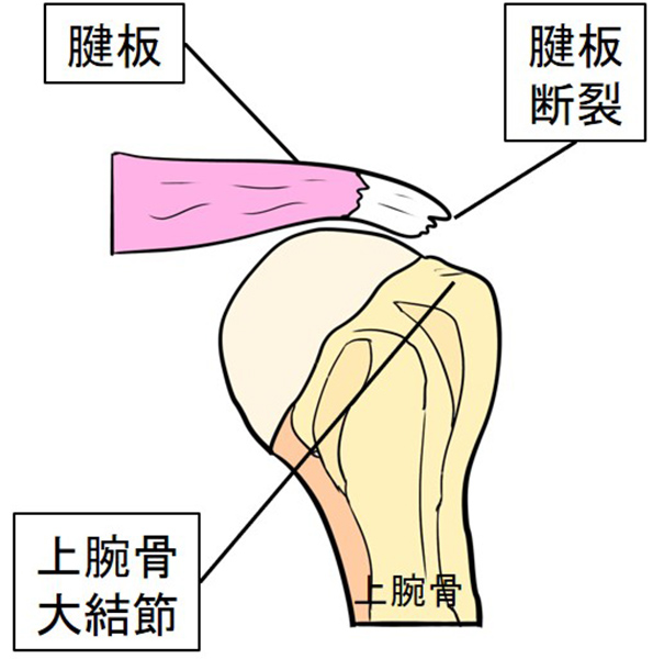 図3：肩腱板断裂