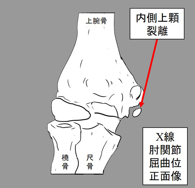 図4：内側上顆裂離