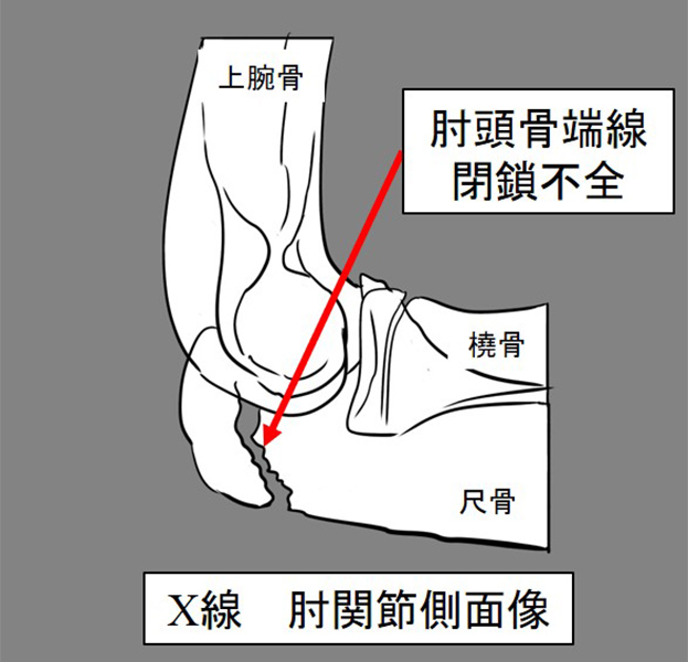 図6：肘頭骨端線閉鎖不全