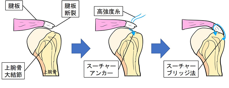 図11：鏡視下腱板修復術